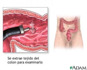 Cáncer colorrectal. Rectosigmoideoscopia. Cáncer colorrectal. Rectosigmoideoscopia.