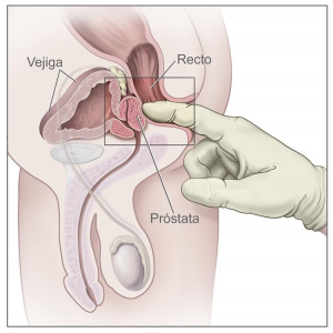 Cáncer de Próstata Cáncer de Próstata