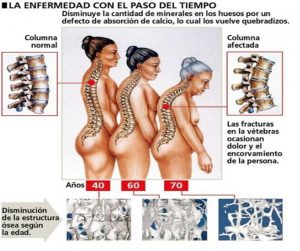 Enfermedad ósea con el paso del tiempo Enfermedad ósea con el paso del tiempo