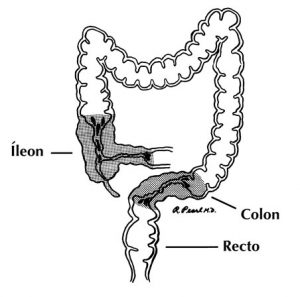 Enfermedad de Crohn