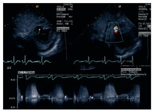 Ecocardiografía Trombo Coronario