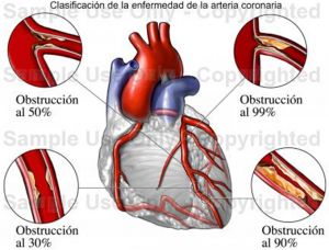 Trombo Coronario