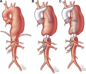 Tratamiento Arteritis Takayasu