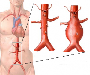 Arteritis de Takayasu