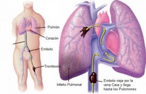 Embolia Pulmonar