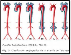 Clasificación Arteritis de Takayasu