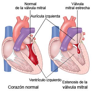 Anatomía corazón, Estenosis mitral