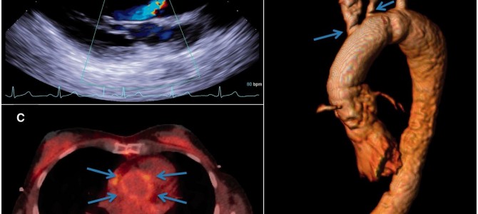 “Arteritis de Takayasu”, por Olga Palubyak