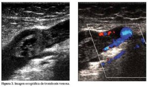 Ecografía, Trombosis Venosa Profunda