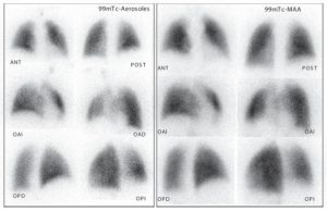 Gammagrafía pulmonar de ventilación-perfusión.