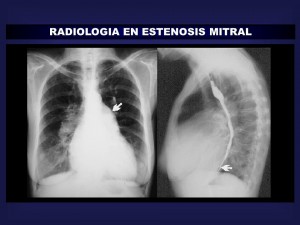 Radiografía de tórax PA y Lateral