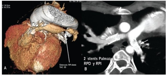 “Estenosis Mitral” por Noelia Saura Celdrán.