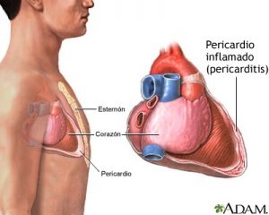 Transtornos del pericardio