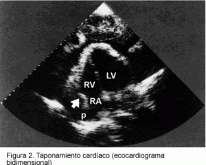 Transtornos del pericardio. Ecocardiograma.