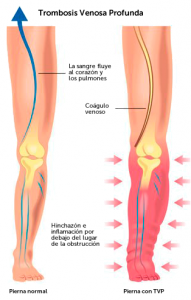 Trombosis Venosa Profunda