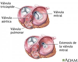 Válvulas corazón, Estenosis mitral