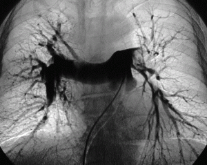 angiografía pulmonar