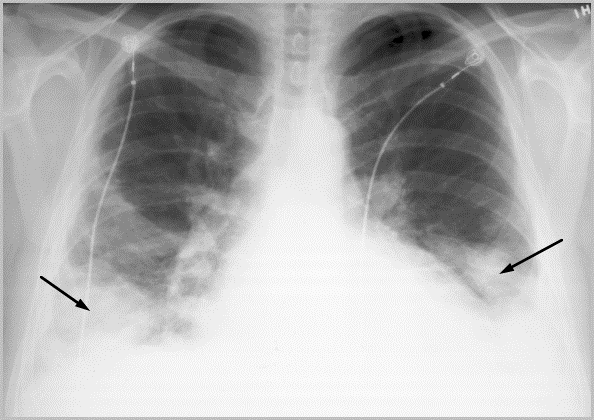 "Embolia Pulmonar" por Cristina Faya y Elisa Martínez.