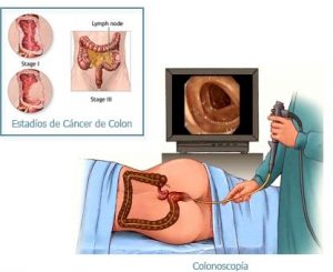 Cáncer colorrectal, Colonoscopia.