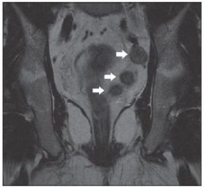 Cáncer colorrectal. RM.