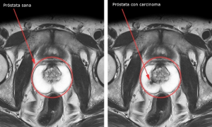 Cáncer de Próstata, RM.