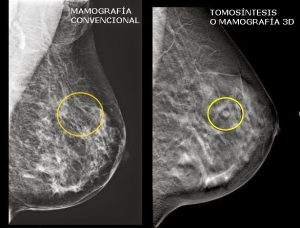 Cáncer de mama. Tomosíntesis.