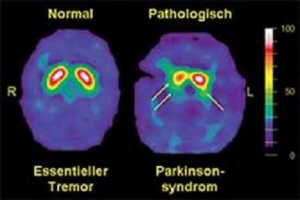 SPECT, PARKINSON