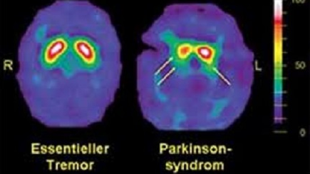 “Enfermedad de Parkinson”, por Antonio Guirao.