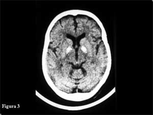 TC CRANEAL, PARKINSON