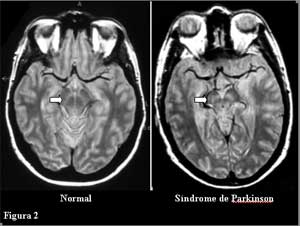 RM, PARKINSON