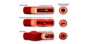 Esquema Arteria Pulmonar, APP.