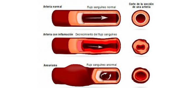 “Patología de la Arteria Pulmonar, APP”, por Francisco Alegría.