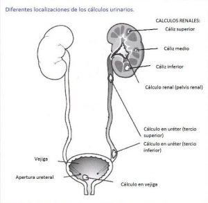 Anatomía del Sistema Renal, Cálculo renal.