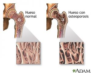 Enfermedad ósea. Osteoporosis.