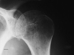 Radio transparencia por perdida de masa ósea en Radiografia simple