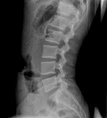 Radiografia de columna vista sagital , de cuerpos vertebrales sin patologia osteoporosica aparente