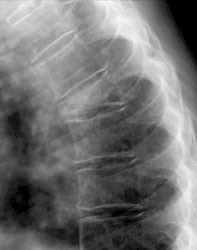 Radiotransparencia en cuerpos vertebrales con lesiones de aplastamiento intervertebral asociado a osteoporosis