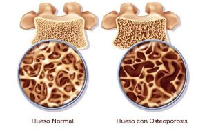 Densidad mineral ósea