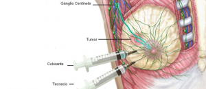 El diagnóstico precoz es el pilar fundamental en la lucha contra el cáncer de mama y el radiofármaco es capaz de emitir radiación gamma que sigue a las células cancerosas. El diagnóstico precoz es el pilar fundamental en la lucha contra el cáncer de mama y el radiofármaco es capaz de emitir radiación gamma que sigue a las células cancerosas. 