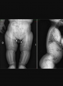 Diagnóstico R(X) de acondroplasia.