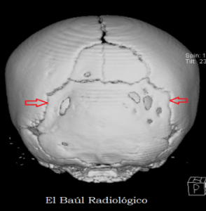 Fusión prematura de las fontanelas, síndrome de Apert.