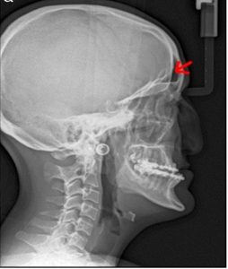 Hipoplasia medio facial.