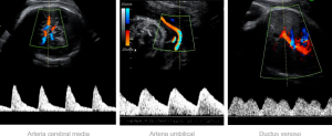 Ecografía, anemia fetal.