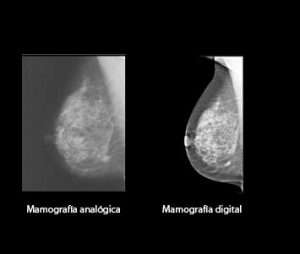 Mamografía, analógica y digital.