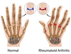 Artritis en articulaciones interfalángicas.
