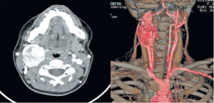 Paragangliomas.