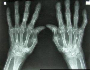 Radiografía de artritis reumatoide.
