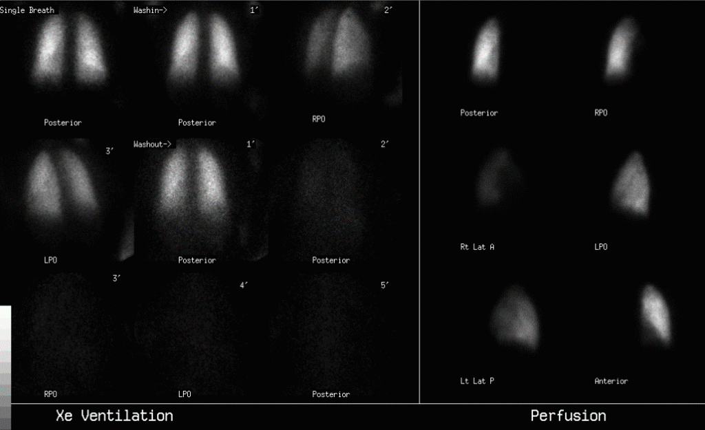 Ventilación pulmonar con xenón133. Ciclo Imagen para el Diagnóstico