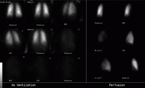 Ventilación pulmonar con xenón-133.