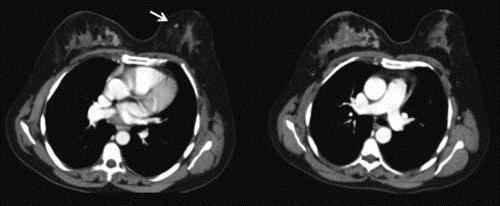 Tomografía Computarizada (TC) en Cáncer de Mama